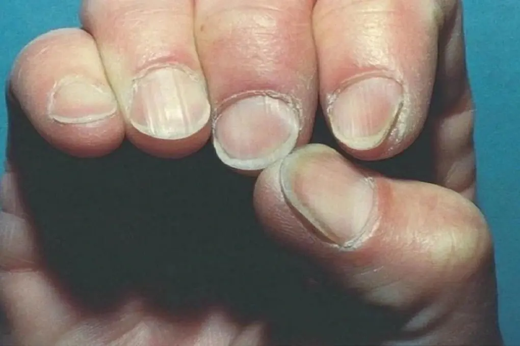 Small change in your fingernails could signal de:adly can:cer before obvious symptoms develop
