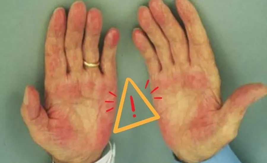 3 signs of fatty liver appear on hands and arms are