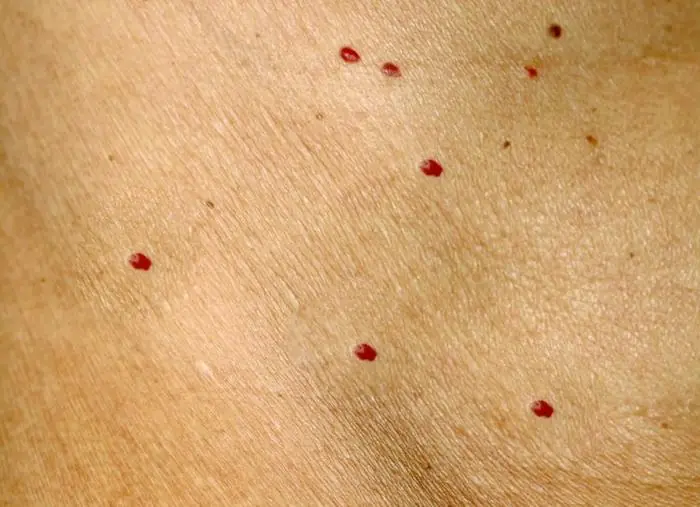 Why Do Red Dots Appear on Your Skin? Causes and What They Could Mean