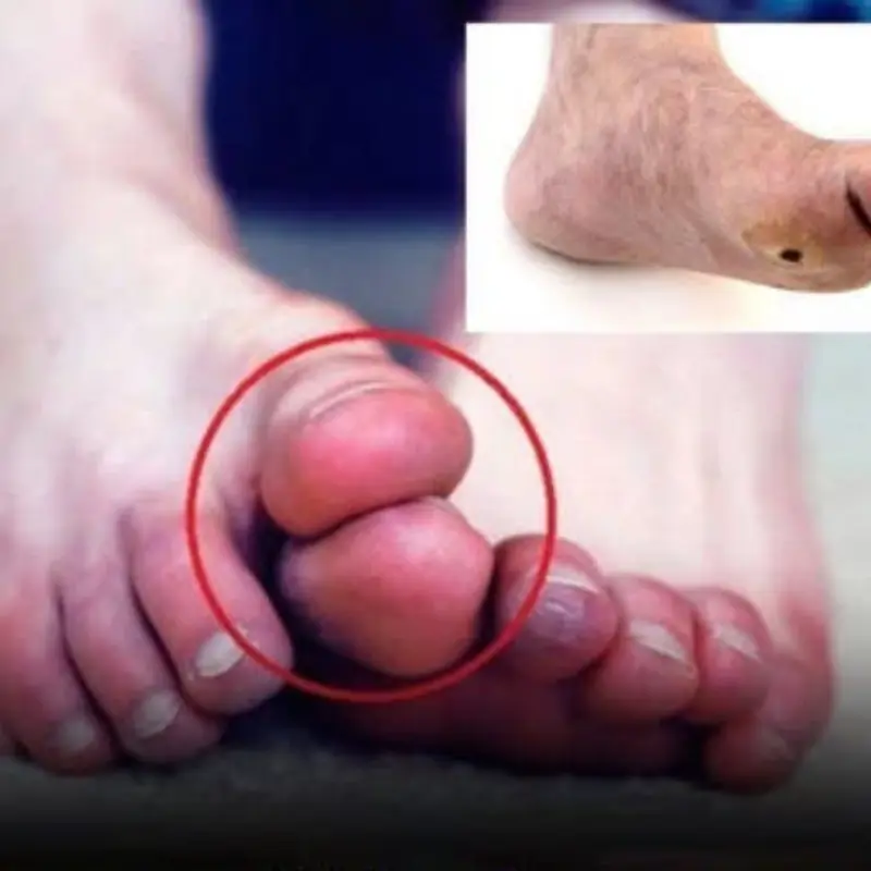Your feet may be warning you about diabetes: Don’t ignore these 5 strange signs