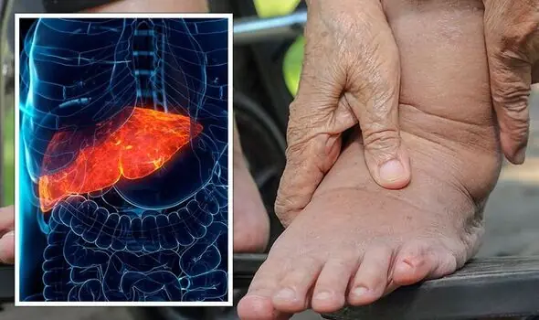Fatty liver disease: The sign in your feet that means the condition is irreversible