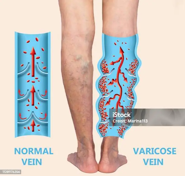 If You Have Poor Circulation, Cold Feet or Varicose Veins, Start Doing these 6 Things
