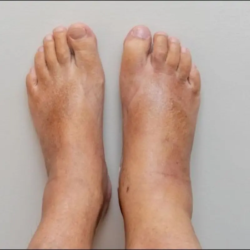 A warning sign in your feet could mean fatty li.ver damage is no longer reversible