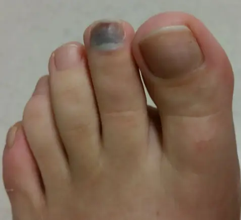 What Causes a Toenail To Turn Black?
