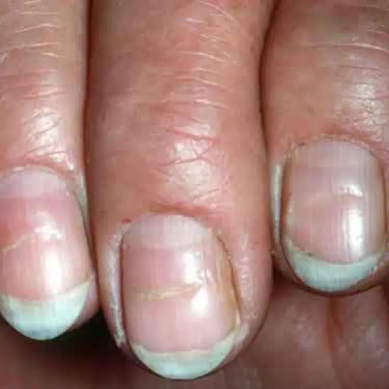 5 Dangerous Conditions Your Nails Could Be Signaling
