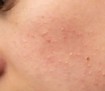 I truly am bothered by these!