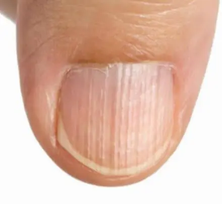 11 Health Warnings Your Fingernails May Be Sending