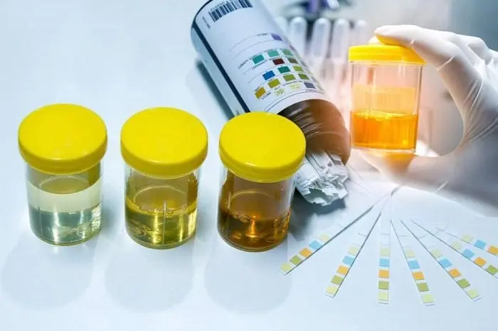 Changes in urine color and odor may indicate underlying liver or kidney issues
