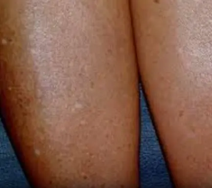 Have you noticed small white spots on your arms or legs… and you don't know what they are?