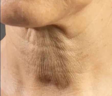 If your neck is starting to sag, don’t ignore it. This is why it happens