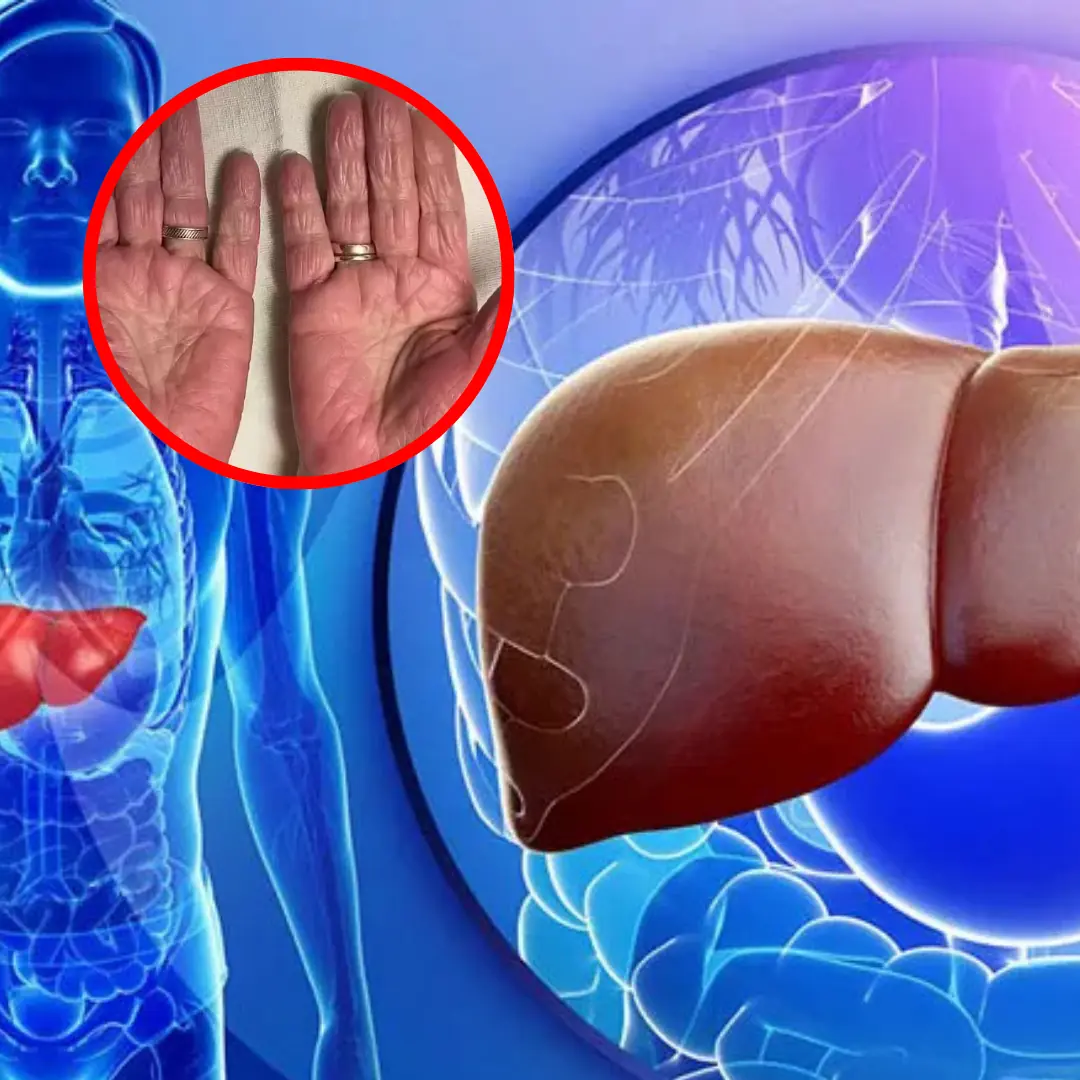 People with liver failure often have 3 characteristics on their hands, if you have 1 you should see a doctor soon