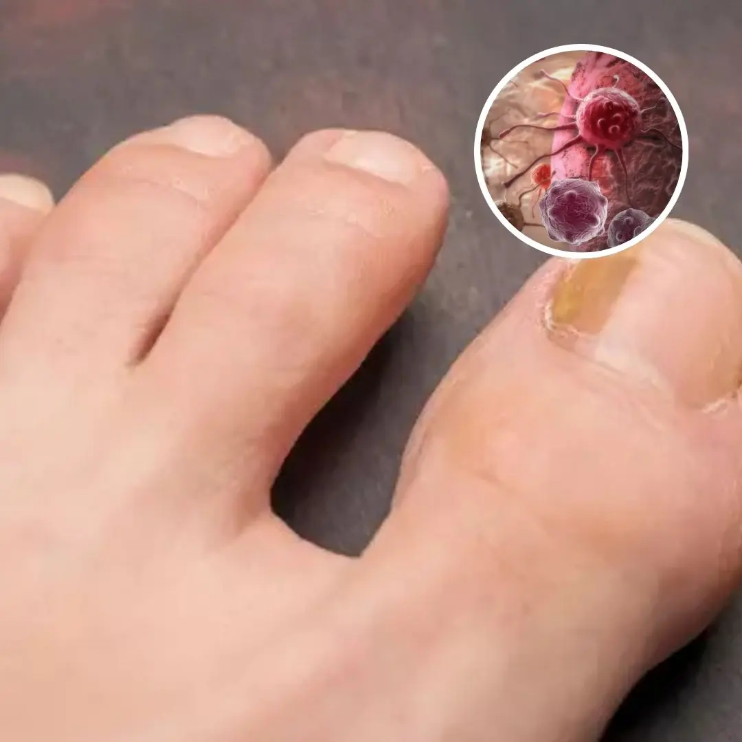 Doctors warn of little-known cancer symptom you can see on your toenails