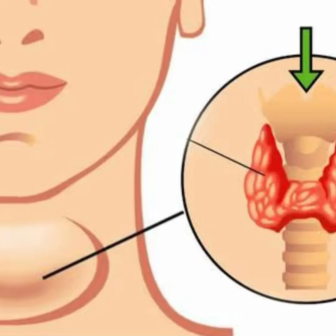 Thy.r.o.id can.cer warning: 7 early body changes, and the first 3 are surprisingly common