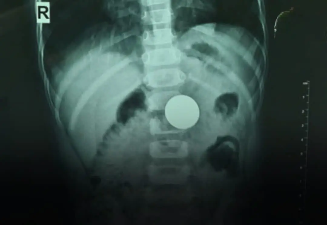 A 3-Year-Old Nearly Died After Swallowing a Shocking Object — What Doctors Found Left the Mother in Tears