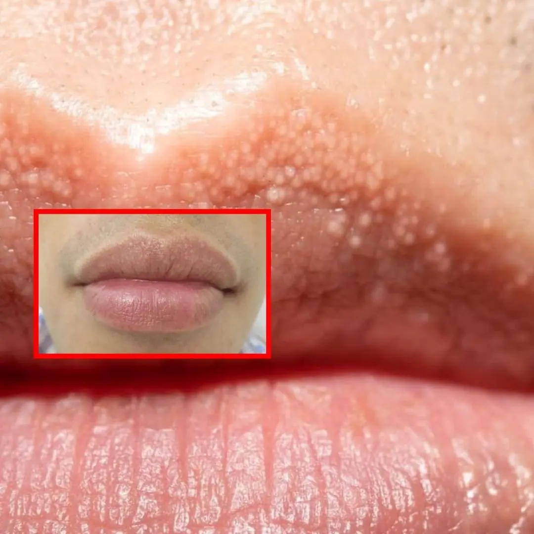 White Spots on Lips: The real causes & how to get rid of them