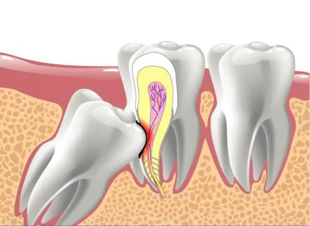 6 Common Symptoms of an Impacted Wisdom Tooth