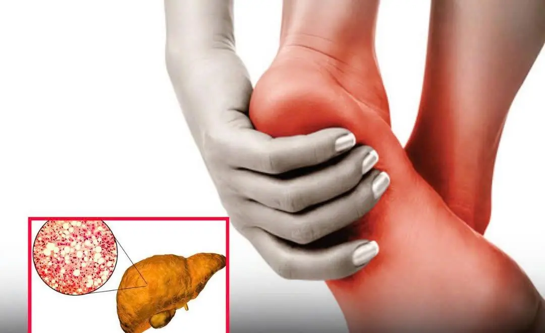 If You Notice This Change in Your Feet, Your Fat:ty Liver May Be Beyond Repair