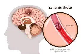 9 silent signs of a brain blood clot that may appear weeks before a stroke