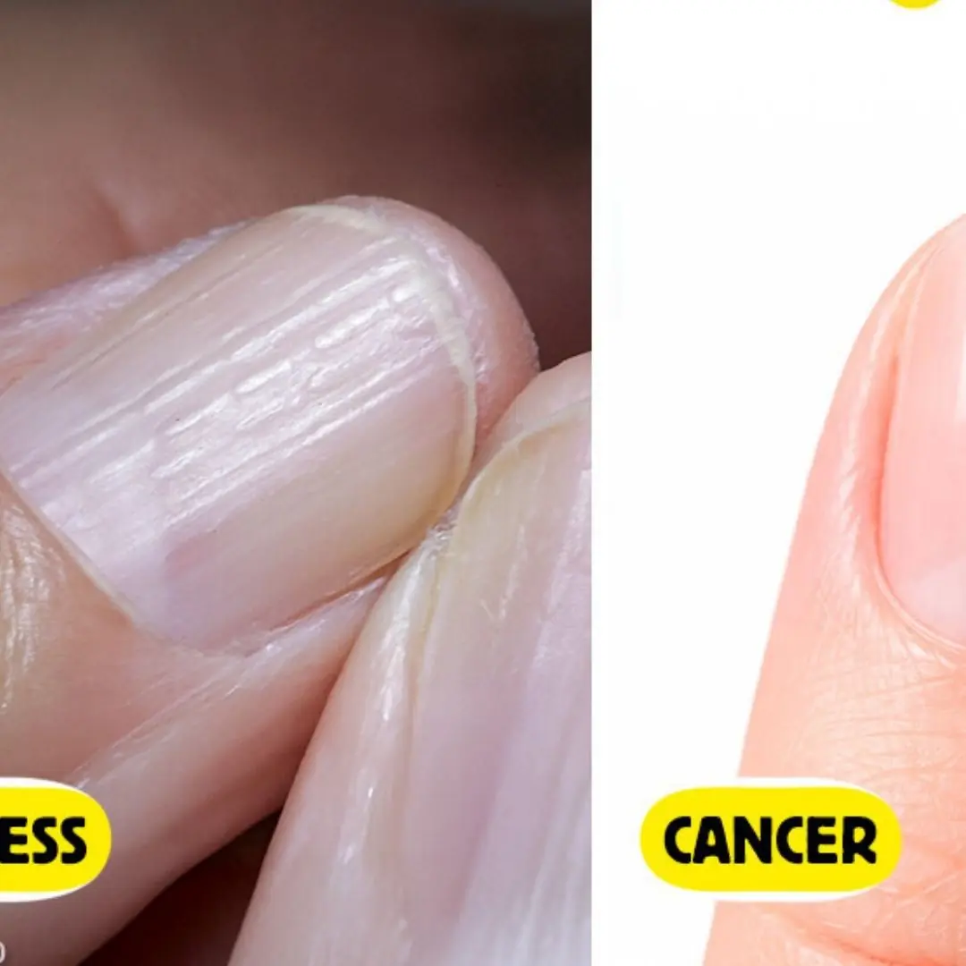 What Your Nails Can Tell You: 5 Serious Health Warnings