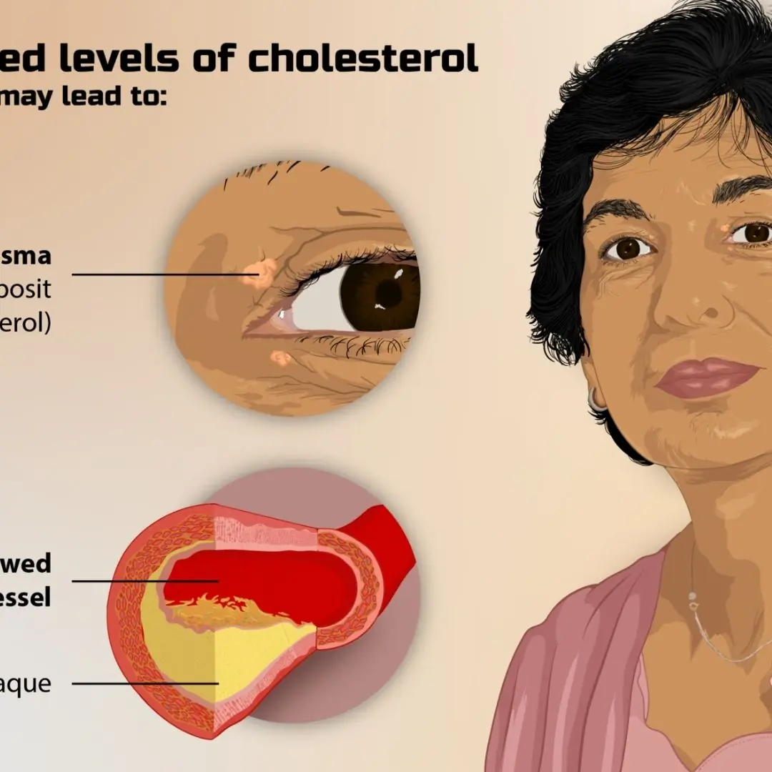 Red Flags That May Mean You’re at Risk of High Cholesterol