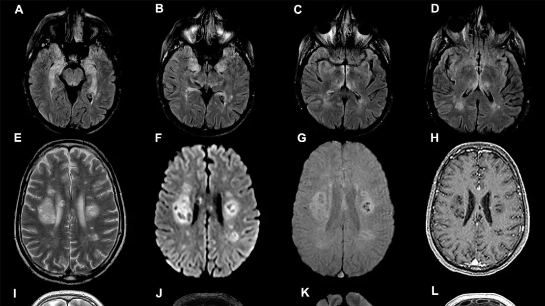 Symptoms of a Brain Tumor You Should Never Ignore