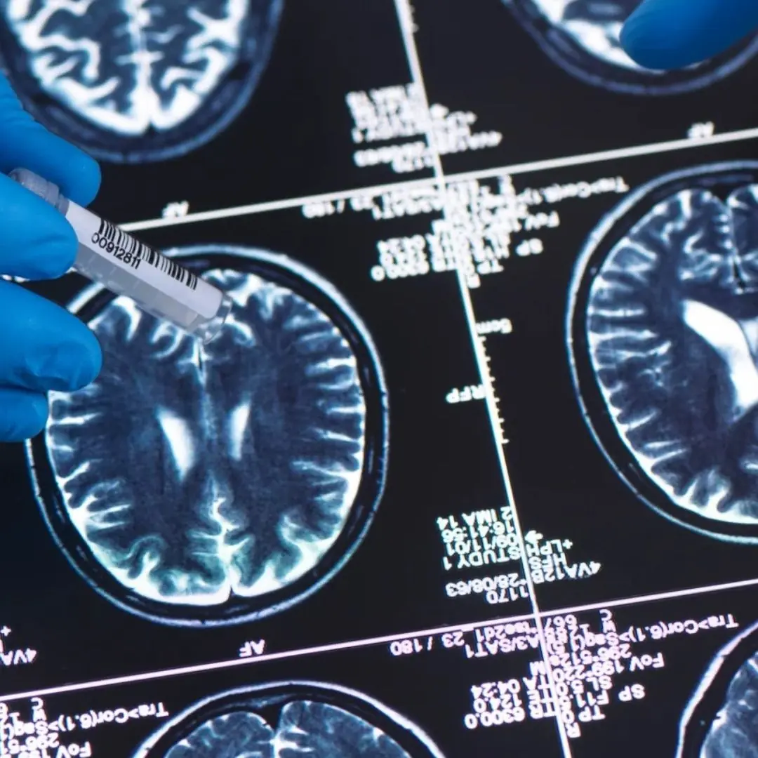 Hard to Detect but Dangerous: Subtle Brain Tumor Signs to Watch For