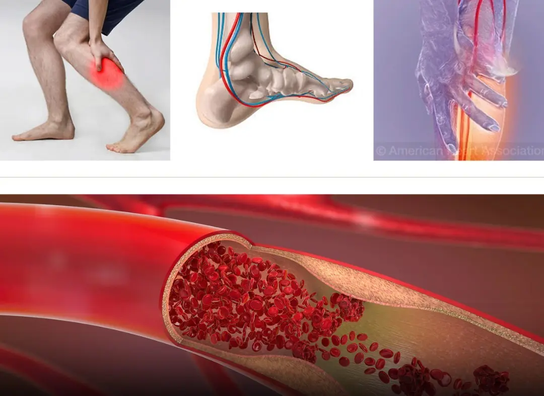 What Your Feet and Legs May Be Telling You at Night