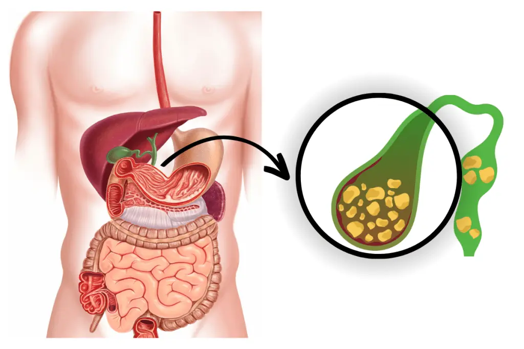 Gallstones are a common disease, affecting 8-10% of the population. Here are the symptoms and treatments