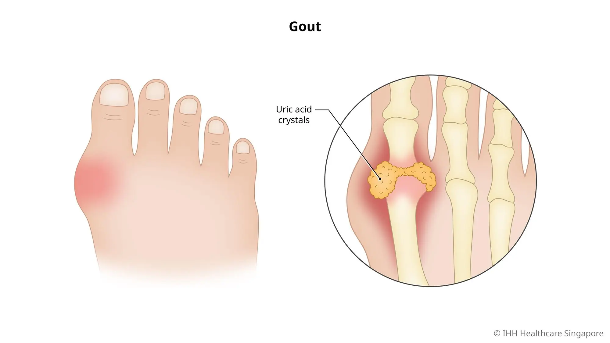 Gout is on the rise: Never touch these foods if you don't want the pain to flare up!