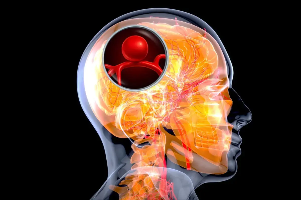 12 signs that may signal a brain aneurysm — Don’t ignore them