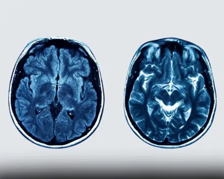 When the Brain Begins to Consume Itself: The Hidden Costs of Chronic Sleep Loss