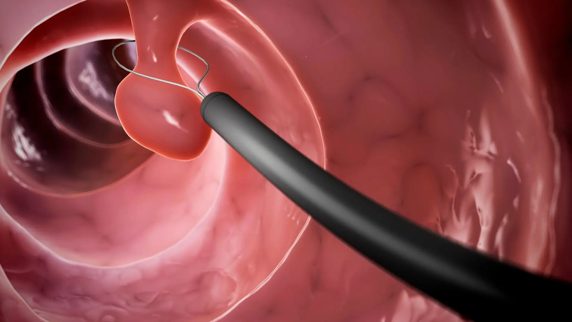 Early Detection of Colon Polyps Can Help Prevent Cancer