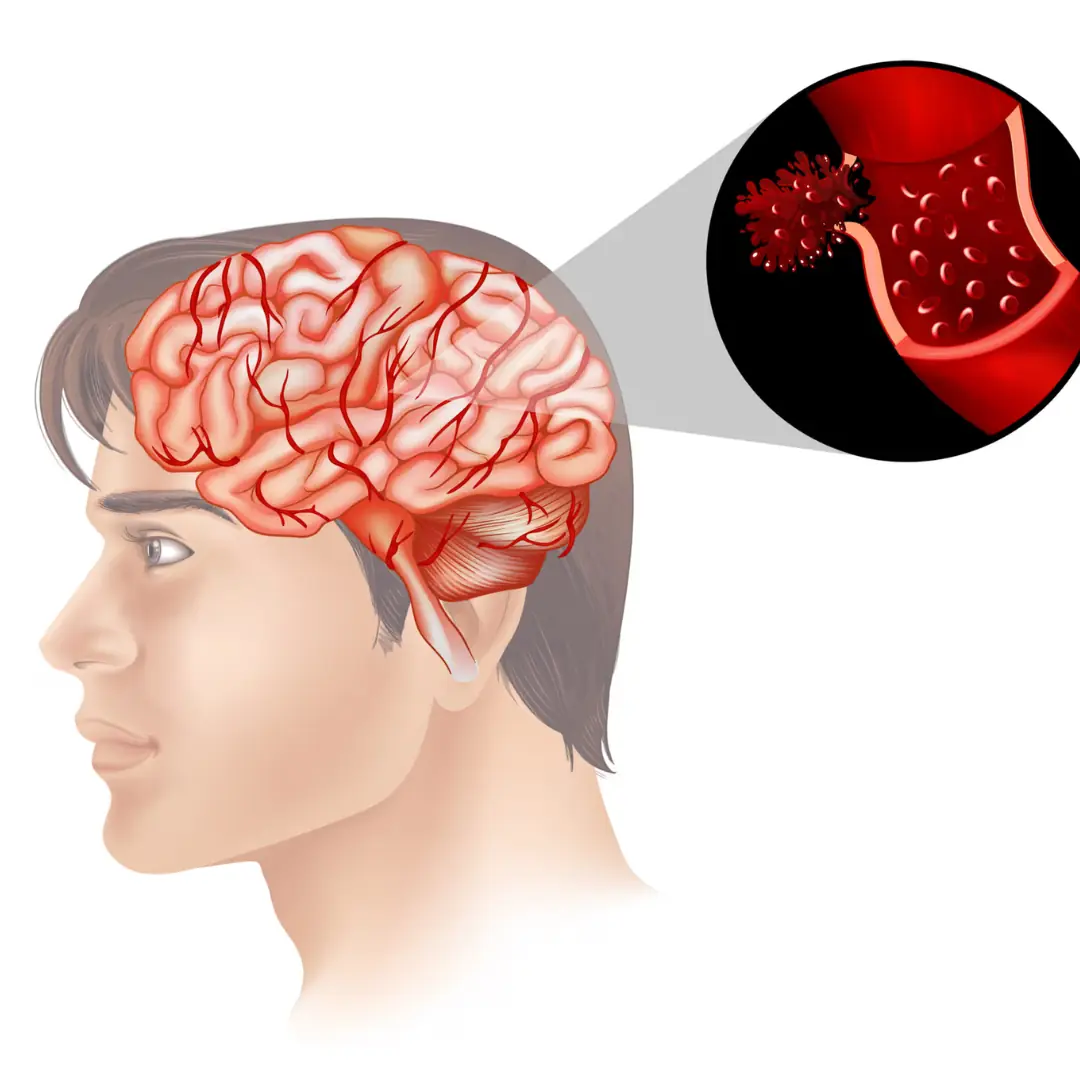 4 Common Morning Habits That May Increase Stroke Risk — and Should Be Avoided at Any Age