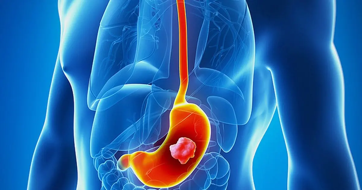 Doctors warn: 5 after-meal symptoms linked to late-detected stomach can.cer