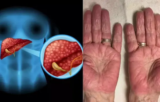 14 Symptoms of Liver Damage You Need to Know