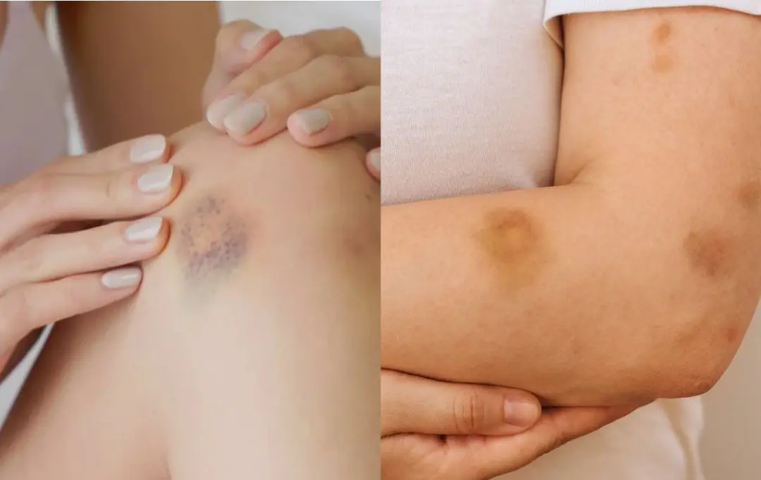 BE CAREFUL, if you get these bruises on your body, here’s what it means....