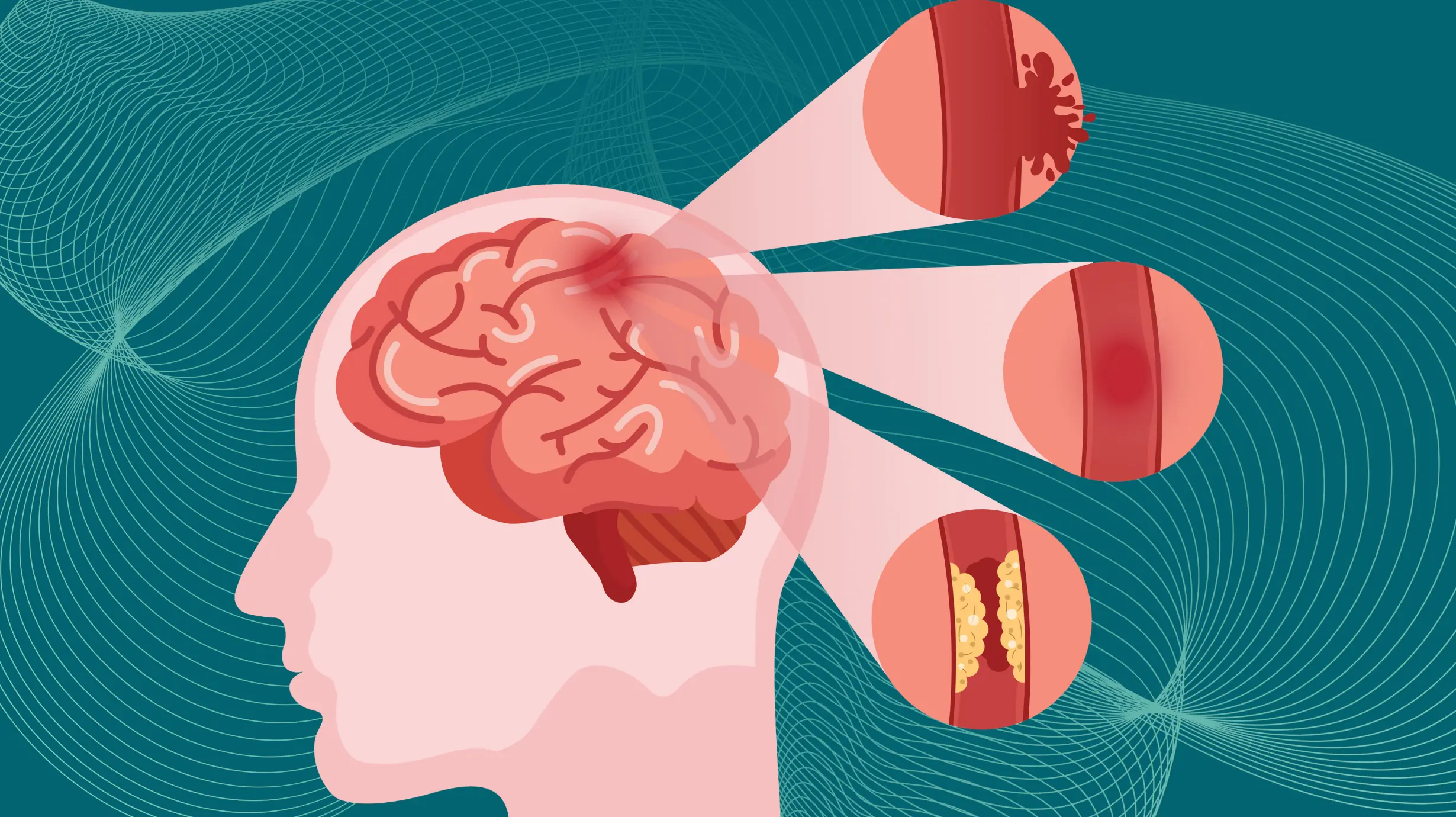 Preventing Stroke At Any Age: 3 “Don’ts” After Meals — And 4 “Don’t” Before Bed