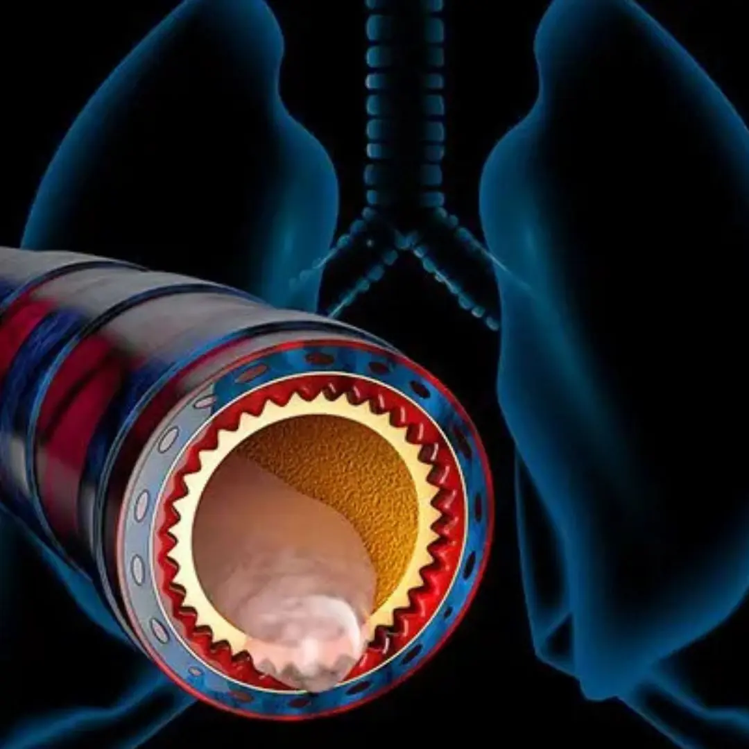 How to get rid of phlegm and mucus in your chest and throat