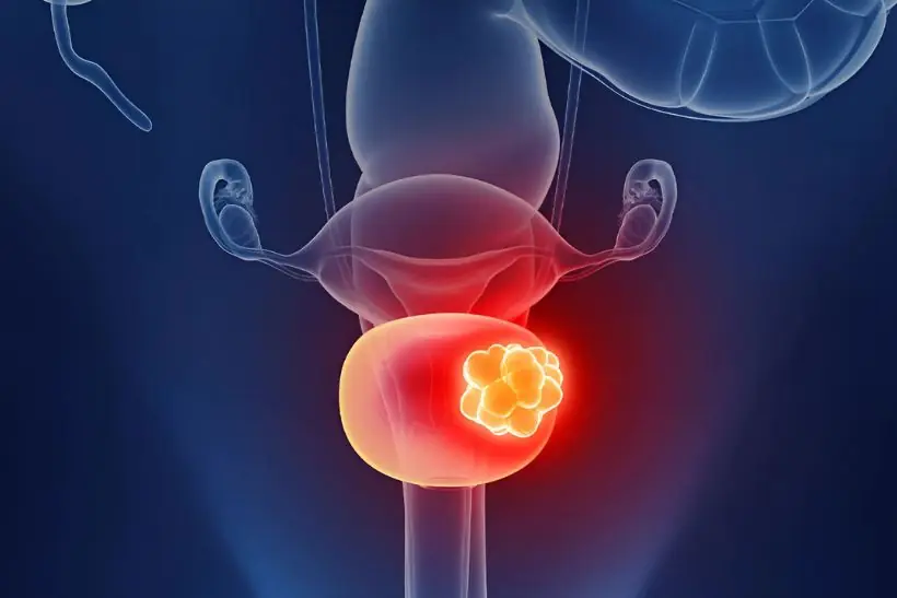 Bladder Cancer: 5 Subtle Early Symptoms to Watch Out For