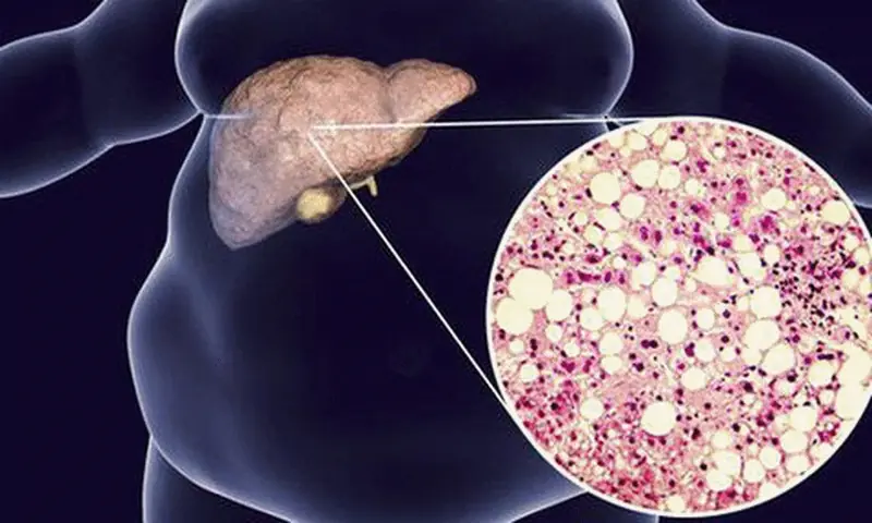 Not Exercise, Just One Lifestyle Change Can Cut the Risk of Fatty Li.ver Disease, Cardiovascular Disease, and Early De.ath by 48%