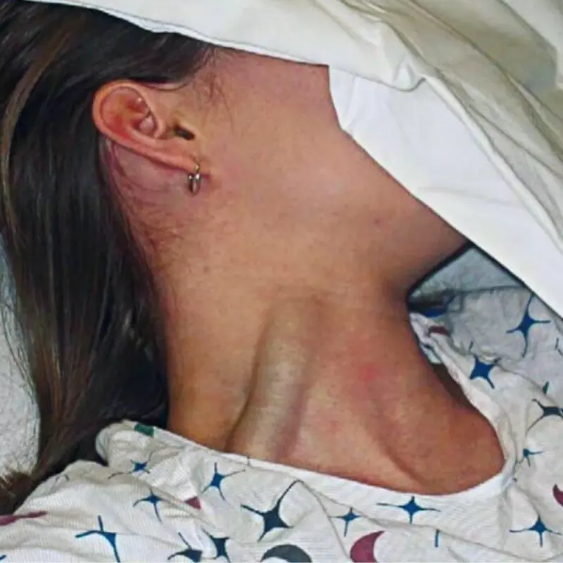 Massive Jugular Distension: A Warning Sign You Should Not Ignore