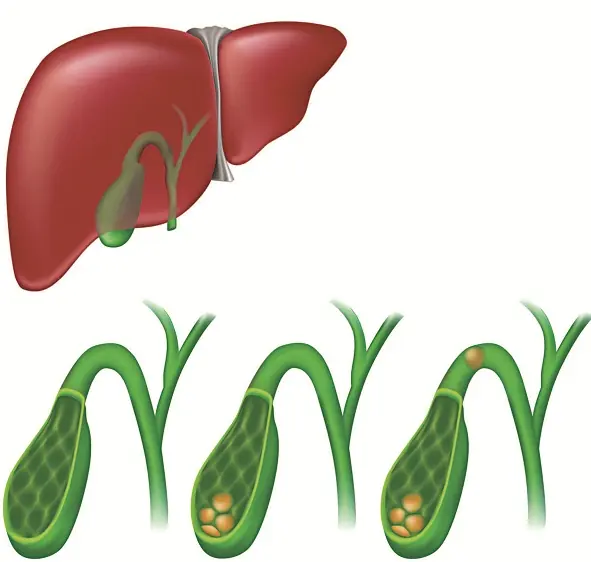 6 silent symptoms warning of gallbladder cancer
