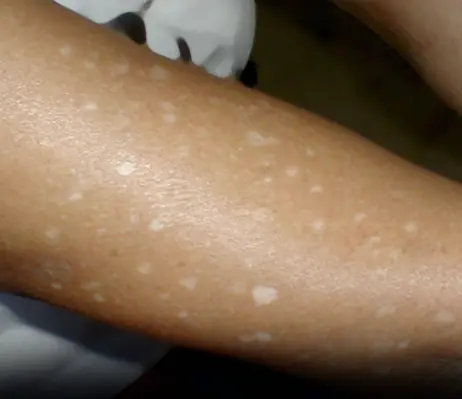 Have you noticed small white spots on your arms or legs… and you don't know what they are?