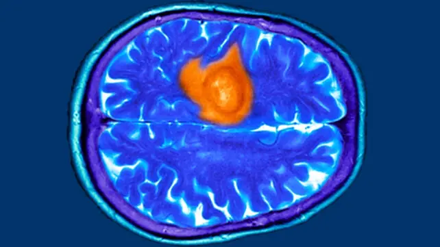 7 Possible Brain Cancer Symptoms Every Woman Should Be Aware Of