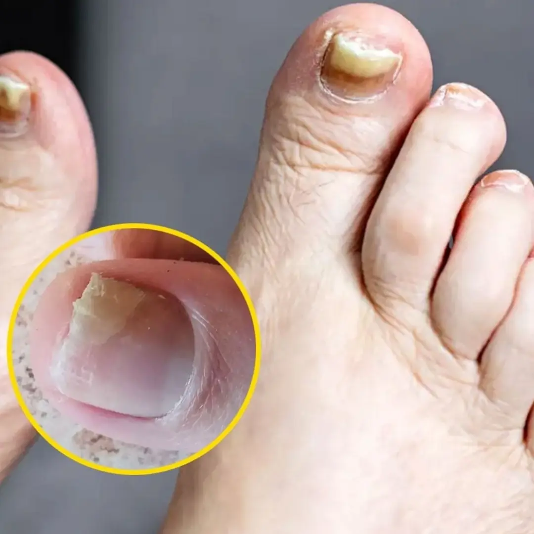 Two Warning Signs Of Silent Kil:ler That You Might Spot In Your Feet