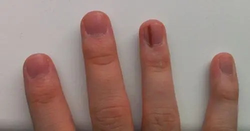 Doctors Warn: 3 Nail Symptoms That May Indicate Underlying Health Issues