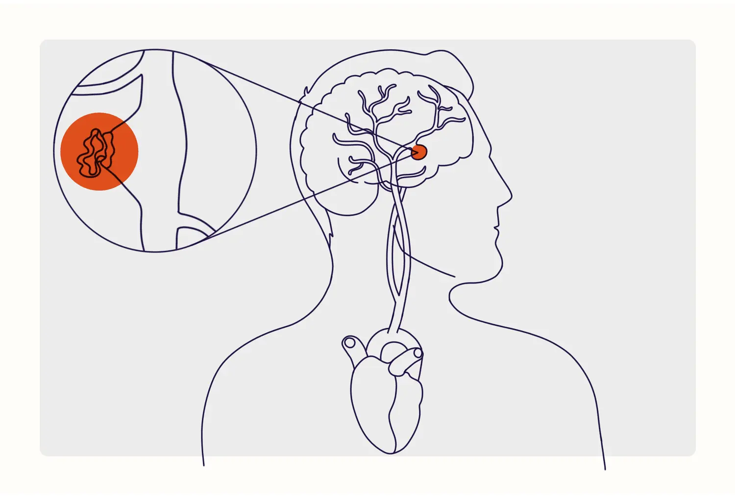 Warning Signs of an Aneurysm: Don’t Ignore These Life - Threa:tening Symptoms