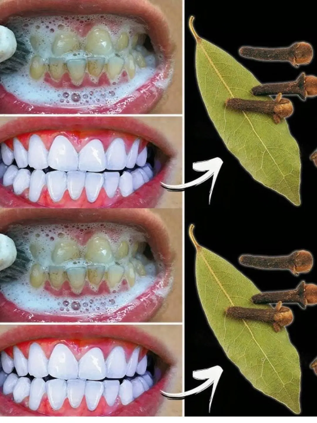 The “2-Minute Miracle” for Tartar Removal and Teeth Whitening: What This Viral Image Gets Wrong