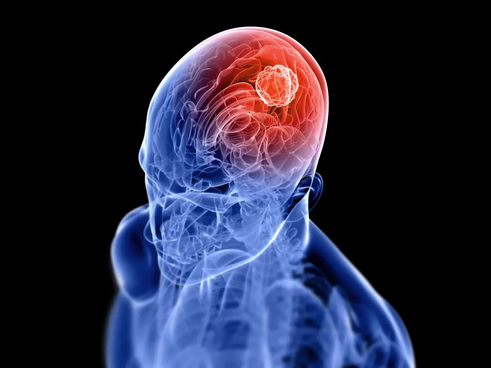 Doctors Warn: Two Uncommon Headache Symptoms May Indicate a Brain Tumor