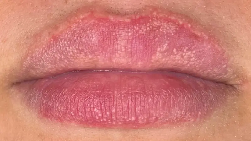 Reason people get strange white bumps on their lips or private parts